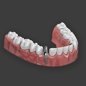 Cemented Restoration