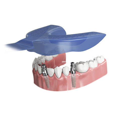 Prosthetics Impression Coping