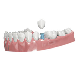 Temporary Abutments Procedure