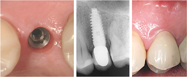 Implant Procedure Flow